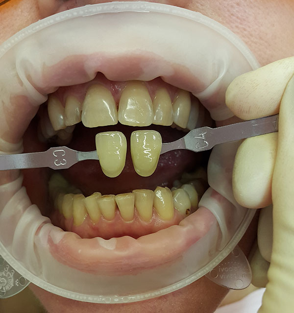 отбеливание на несколько тонов отбеливание на несколько тонов